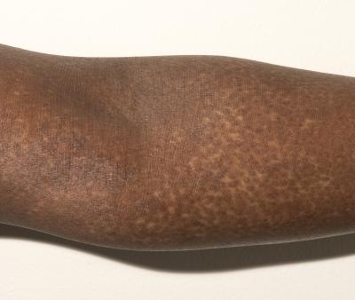 A Reframe project photo of a volunteer's skin condition